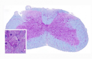 Gene-therapy-of-the-neurological-manifestations-of-Pompe-disease