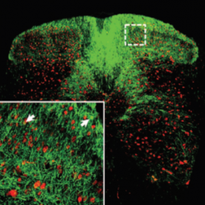 Intrathecal-gene-therapy-for-moderate-forms-of-spinal-muscular-atrophy